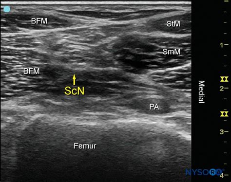 Popliteal Nerve Block Ultrasound