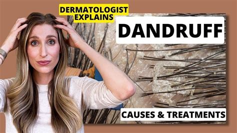 Dermatologist Explains Dandruff What Causes It And Best Dandruff