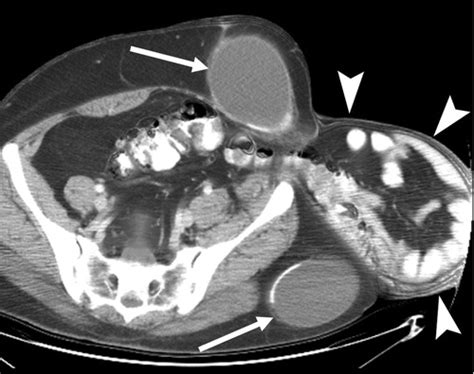 Axial Ct Scan Of The Abdomen Showing An Obturator Hernia On The Left