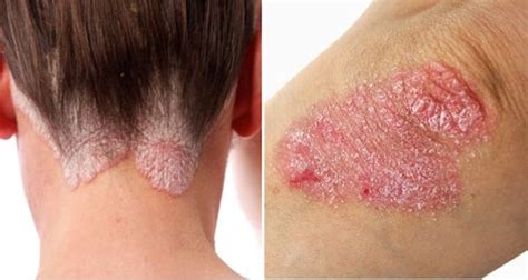 How To Detoxify And Get Rid Of Psoriasis Once And For All Psoriasis