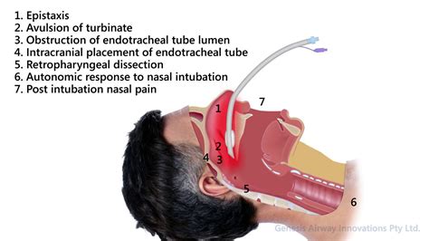 Complications Of Nasal Endotracheal Intubation Youtube