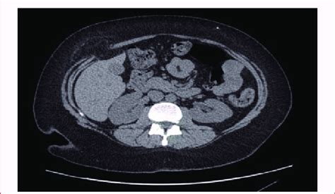 Ct Scan Showing The Defect Of A Spigelian Hernia About 3 Cm In