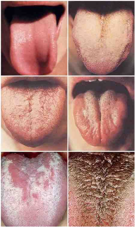 Viral White Spots Throat Sore Throat Drops Nasal Stones