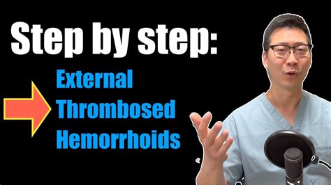 Step By Step Guide External Thrombosed Hemorrhoids Youtube