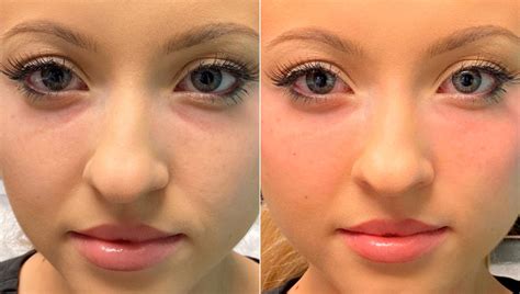 Under Eye Surgery Before And After