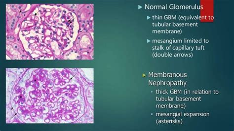 Membranous Glomerulonephritis
