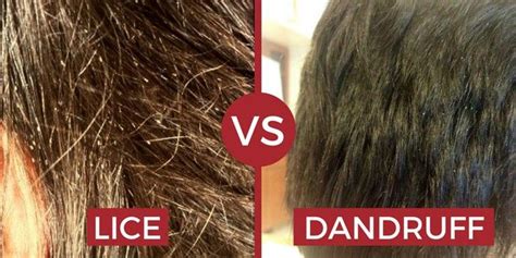 However, the lice which are found in humans are different from pets like dogs and cats. Lice vs Dandruff (How To Tell What You Have?) | Louse ...