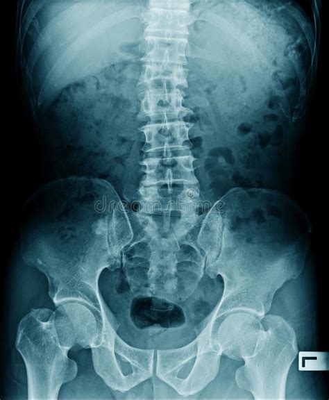 Spondylosis And Scoliosis Film X Ray Lumbar Sacrum Spine Show