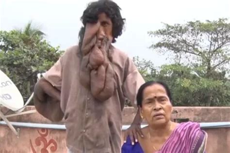 Elephant Man With Trunk Due To Rare Condition Is Revered As God But Needs Miracle Surgery
