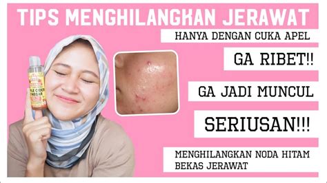 Cara Menghilangkan Jerawat Dan Bekas Nya Dengan Cepathanya Dengan