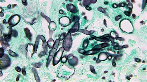 Pathology Outlines Hyaline Molds