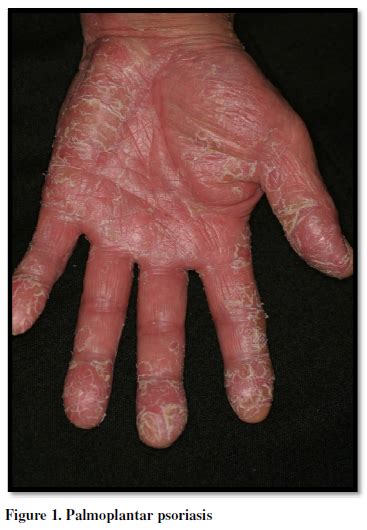 Scitech Palmoplantar Pustulosis A Distinct Entity With A Close