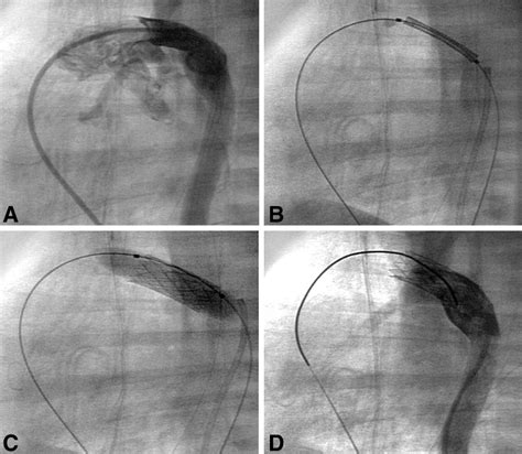 Stenting Of The Arterial Duct And Banding Of The Pulmonary Arteries