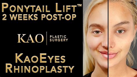 Ponytail Lift Kaoeyes And Rhinoplasty The Trifecta Of Facial