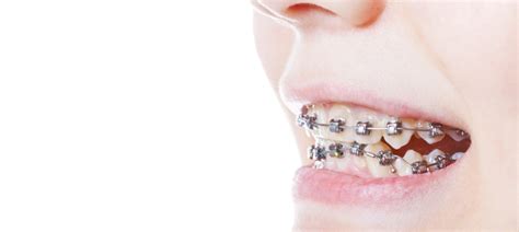 Damon Braces What Are They Benefits And Cost The Teeth Blog