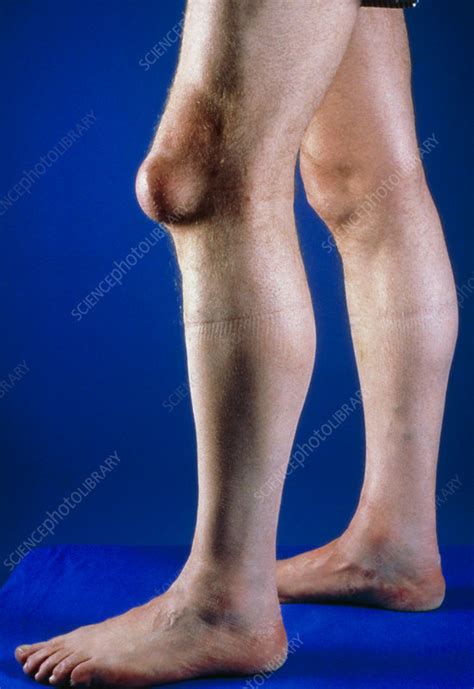 Pre Patellar Bursa Swelling On Knee Stock Image M1200018 Science