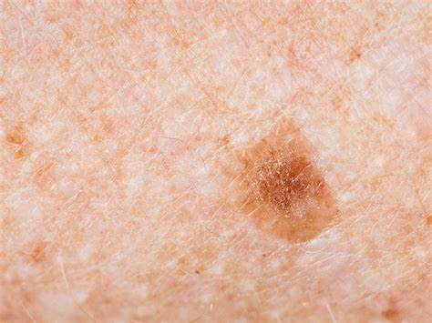 Рак кожи лечение диетой Рак Кожи Лечение Рак Кожи Лечение Рак кожи лечение диетой