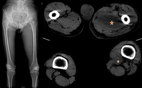 Plain Film And Ct Of The Lower Limbs Comparing The Two Sides Plain