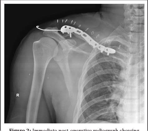 Figure 2 From Segmental Clavicle Fracture With Acromioclavicular Joint