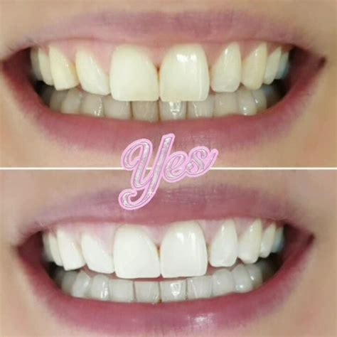 Brighter Whiter Smile Can Be All Yours In 1hr Last Few October