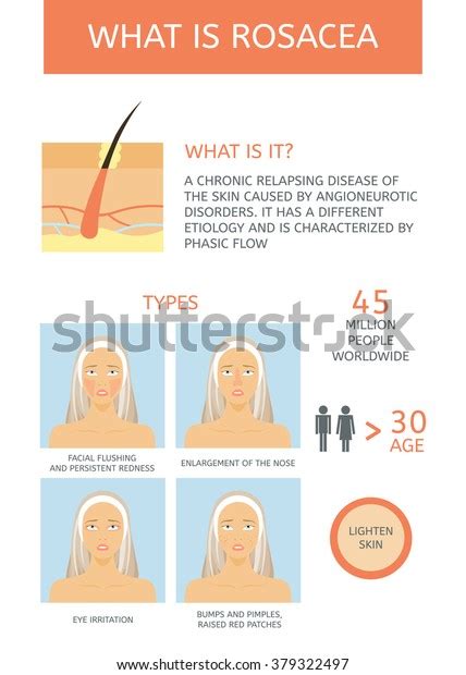 Rosacea Causes Types Facts Infographics Stock Vector Royalty Free