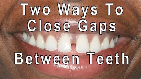 How To Close Gaps Between Teeth Youtube