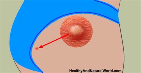 Effective Home Remedies To Get Rid Of Boils On Butt Research Based