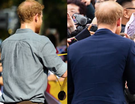 Prince Harrys Bald Patch Has Doubled This Year