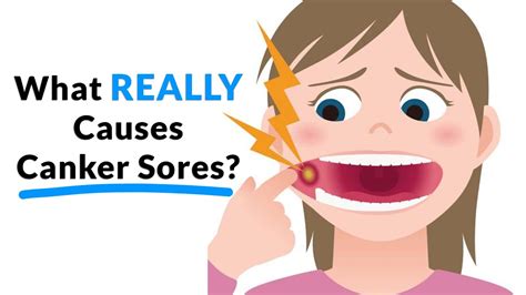 What Really Causes Canker Sores Youtube