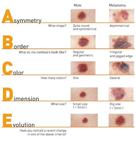 What Are The Different Types Of Malignant Melanoma