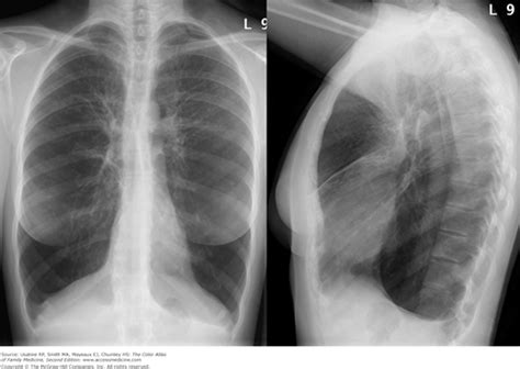 Copd Chest X Ray Bullae Kronis J