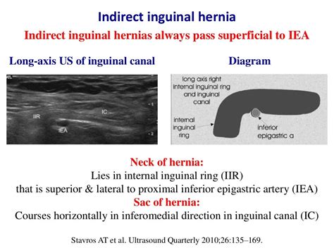 Ultrasound Of Groin And Anterior Abdominal Wall Hernias