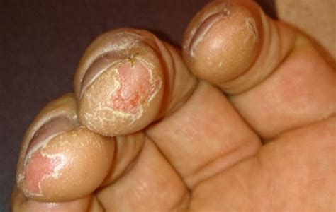 Causes And Treatments Of Cracked Peeling Fingertips Skincarederm