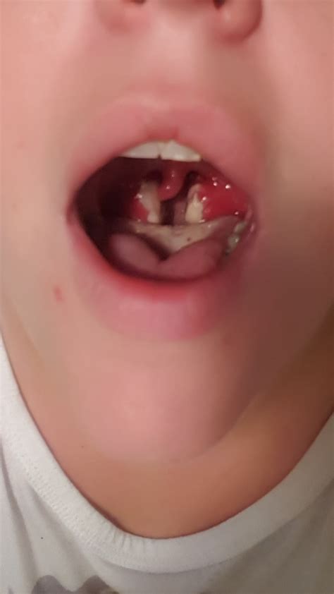 Day 3 of strep and tonsillitis... : r/popping