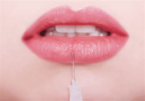Get Fuller Plumper Lips That Look Natural Dutch Hollow Medical Day Spa Medical Spa