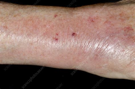 Infected Cat Bite On The Wrist Stock Image C0167240 Science