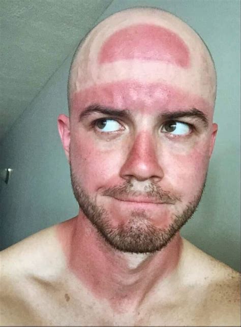 Funny Sunburns And Tanlines