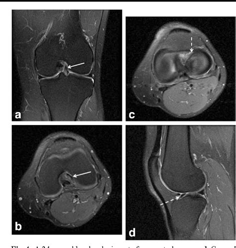 Ziqiao kong (qianxin technology research institute); Figure 2 from Cysts of the anterior horn lateral meniscus ...