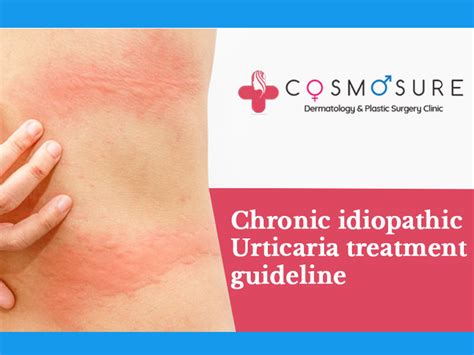 Chronic Idiopathic Urticaria Treatment Guidelines Cosmosure Clinic