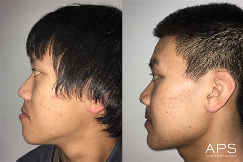 Facial Bone Contouring Before And After Photos For Asian Patients