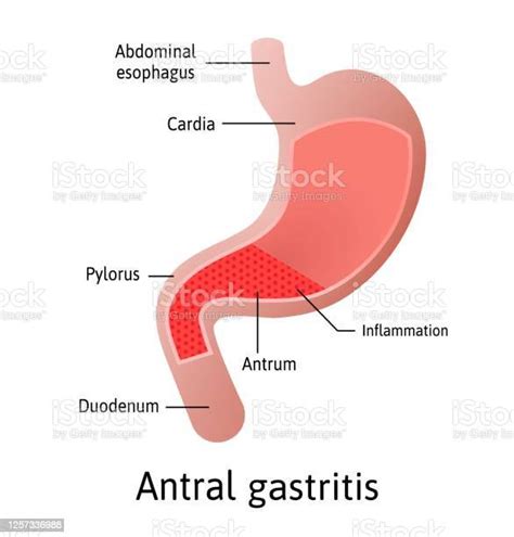 Antral Location Of Gastritis An Inflammation Of The Lining Of The