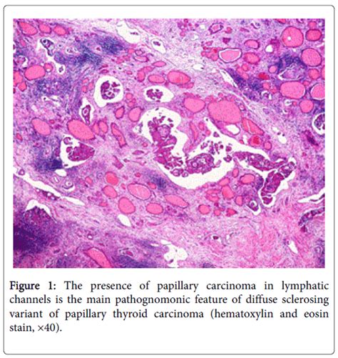 Thyroid Disorders Therapy Papillary Carcinoma