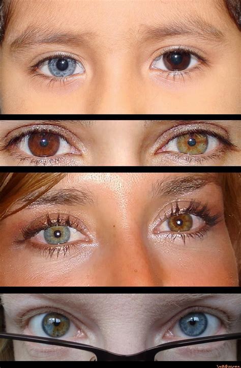 Different Eye Colors In Each Eye