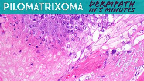 Pilomatrixoma Pilomatricoma Dermpath In 5 Minutes Dermatology