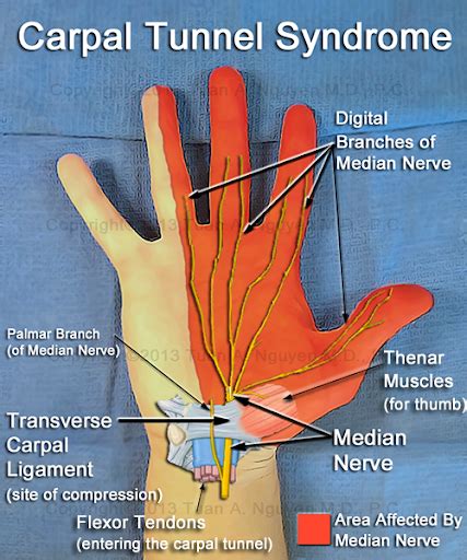 Carpal Tunnel Syndrome Hsse World