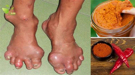Gout Treatment How To Cure Gout Fast At Home All Natural Remedies