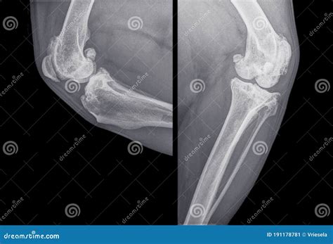 X Ray Of The Knee Of A Dog With Severe Osteoarthritis Stock Image
