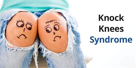 Knocking Knees Know Symptoms Causes And Treatment From Expert