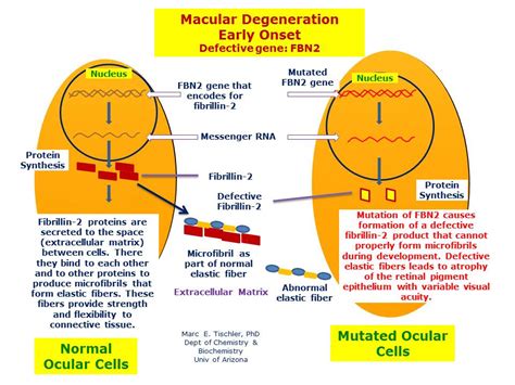 Maybe you would like to learn more about one of these? Macular Degeneration, Early-Onset | Hereditary Ocular Diseases