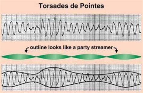Torsades De Pointes Qrs Complexes Jumping On Both Sides Of The Lines